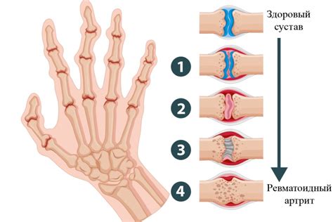 Что делать, если болят суставы пальцев рук?